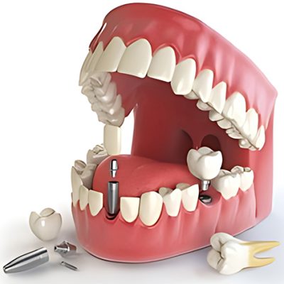 dental-implants